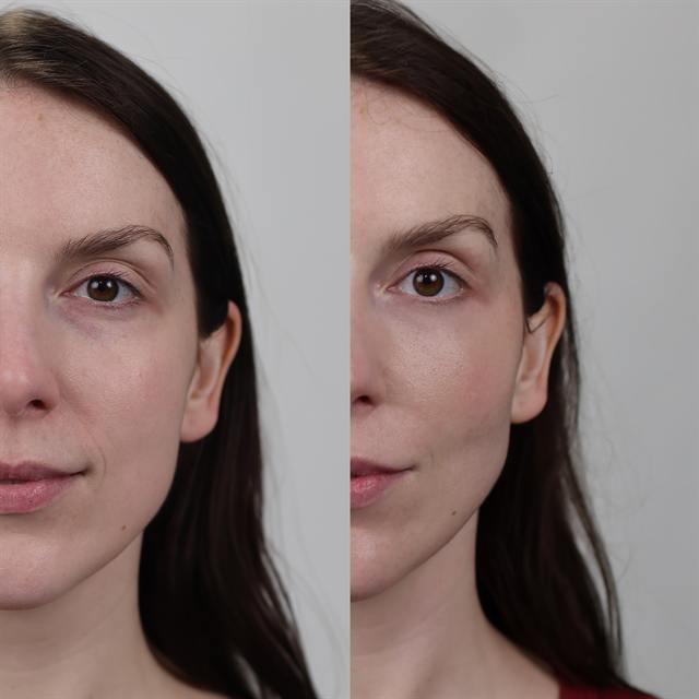 Unretouched before and after result, the drBand Clinic