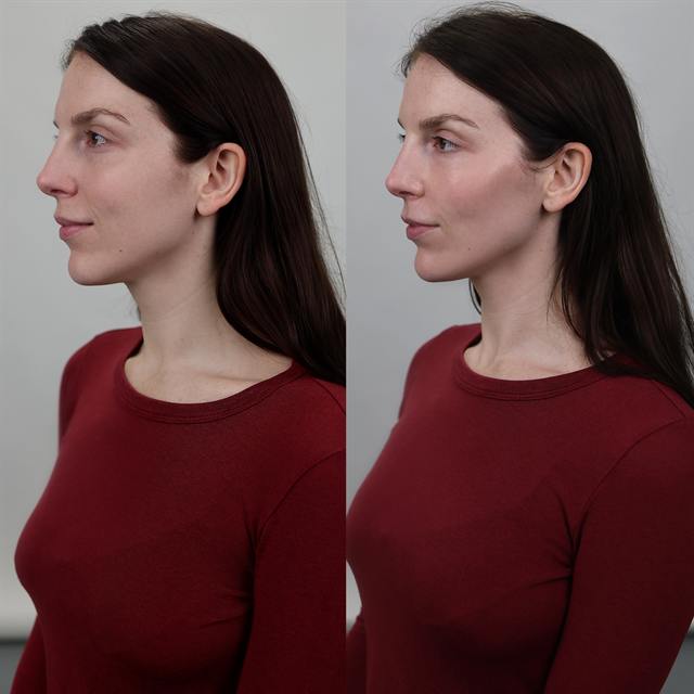 Unretouched before and after result, the drBand Clinic