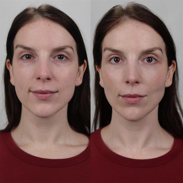 Unretouched before and after result, the drBand Clinic