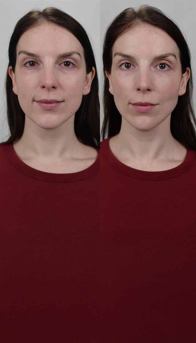 Unretouched before and after result, the drBand Clinic