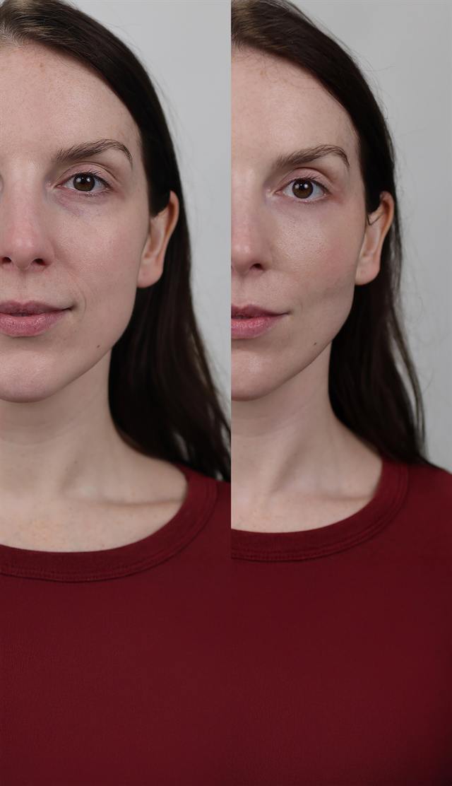 Unretouched before and after result, the drBand Clinic