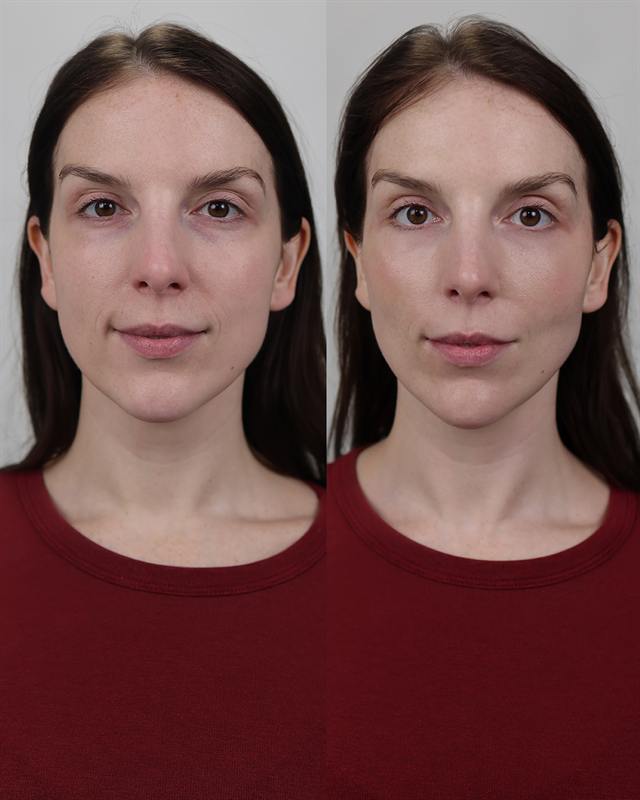 Unretouched before and after result, the drBand Clinic