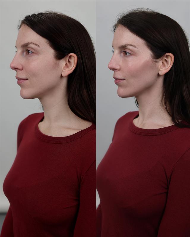 Unretouched before and after result, the drBand Clinic