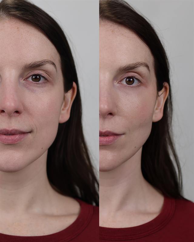 Unretouched before and after result, the drBand Clinic
