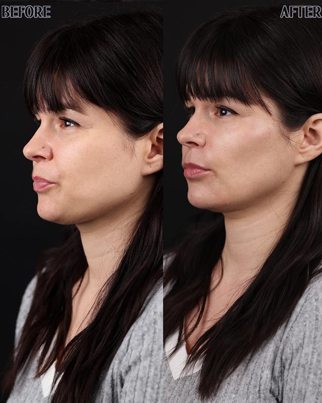 Unretouched before and after result, the drBand Clinic