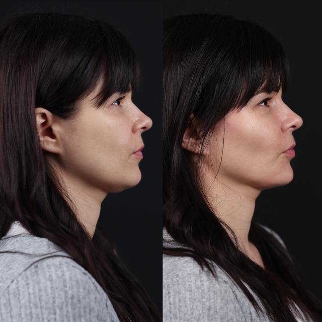 Unretouched before and after result, the drBand Clinic