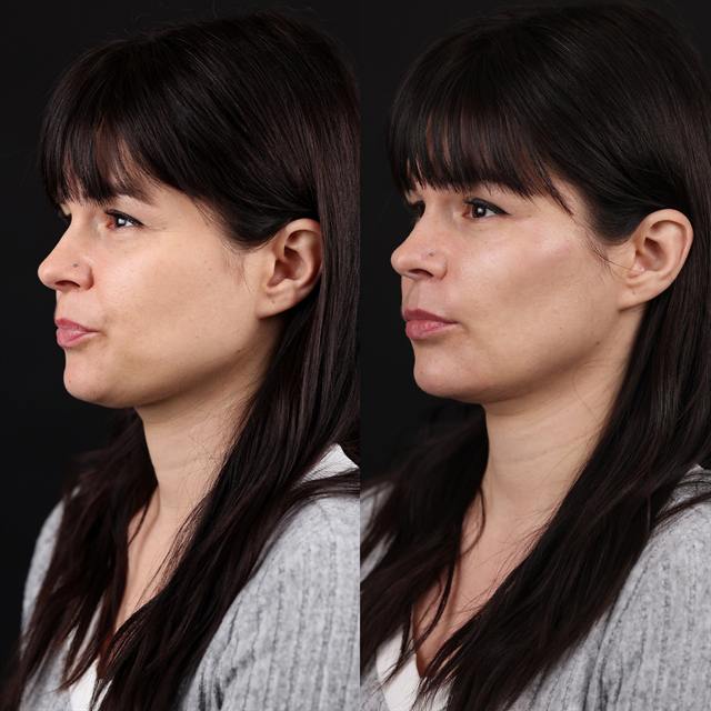 Unretouched before and after result, the drBand Clinic