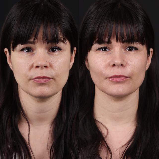 Unretouched before and after result, the drBand Clinic