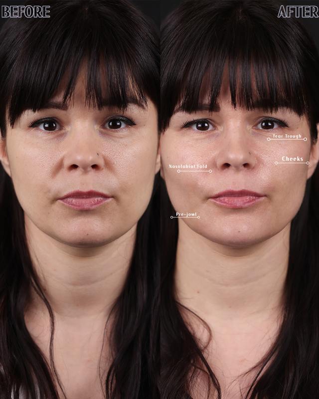 Unretouched before and after result, the drBand Clinic