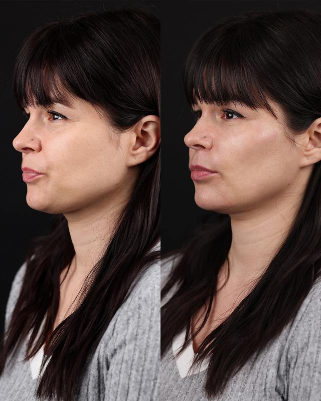 Unretouched before and after result, the drBand Clinic