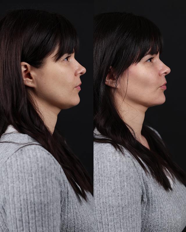 Unretouched before and after result, the drBand Clinic