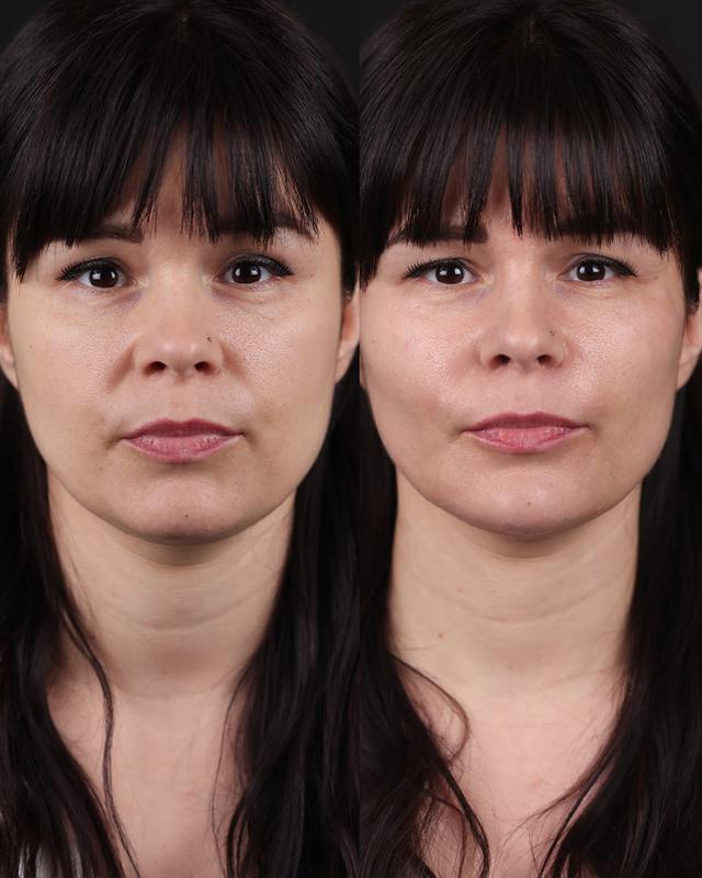 Unretouched before and after result, the drBand Clinic