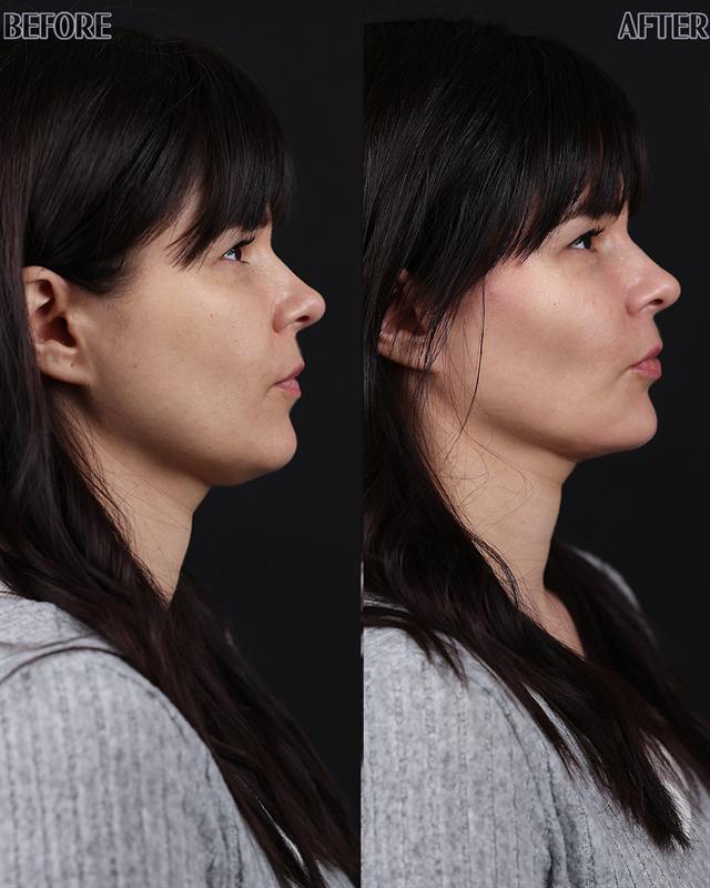 Unretouched before and after result, the drBand Clinic