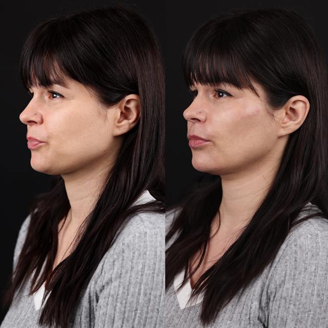 Unretouched before and after result, the drBand Clinic