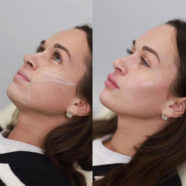 Unretouched before and after result, the drBand Clinic