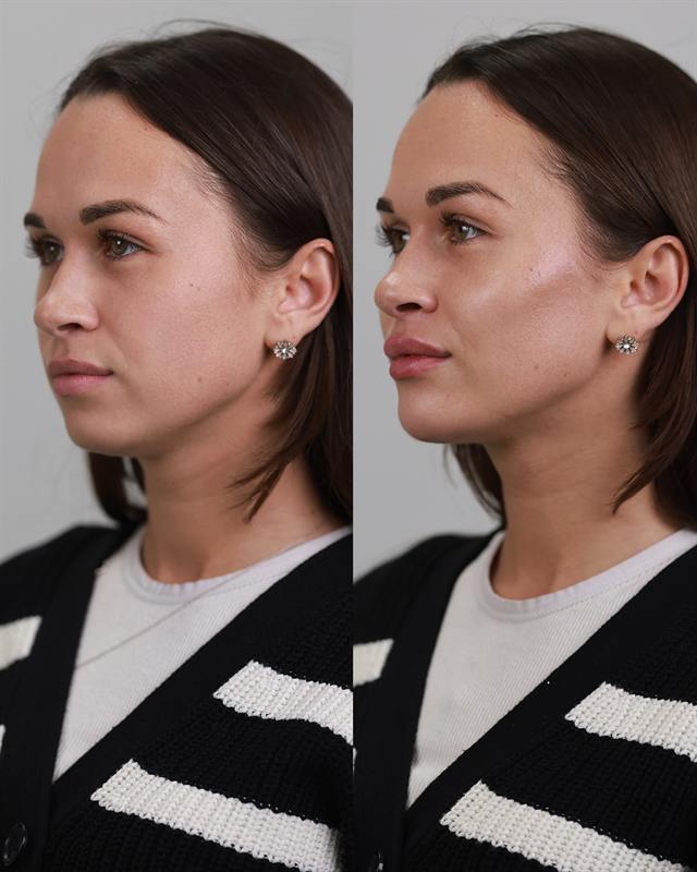 Unretouched before and after result, the drBand Clinic