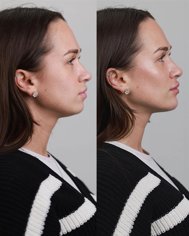 Unretouched before and after result, the drBand Clinic