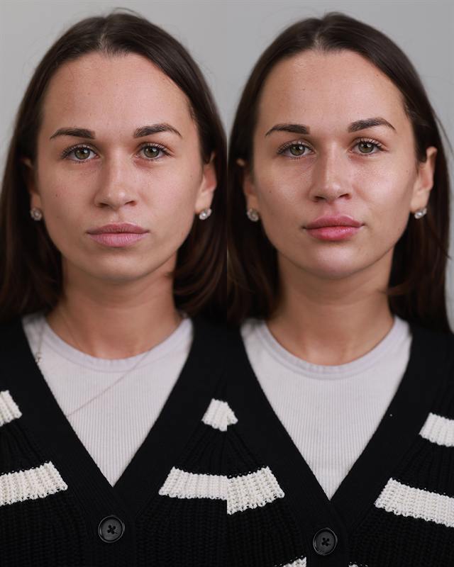 Unretouched before and after result, the drBand Clinic