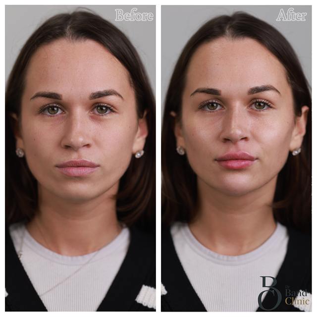 Unretouched before and after result, the drBand Clinic