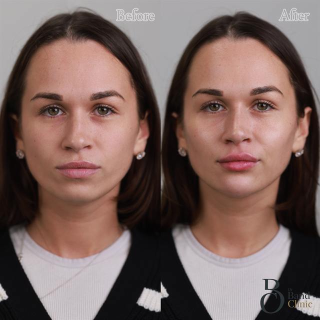 Unretouched before and after result, the drBand Clinic