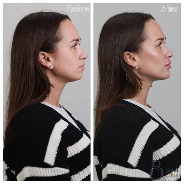 Unretouched before and after result, the drBand Clinic