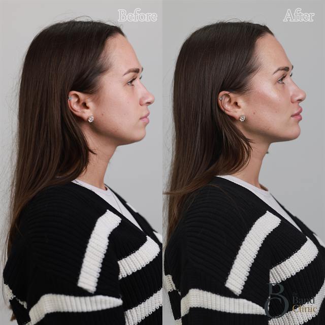 Unretouched before and after result, the drBand Clinic