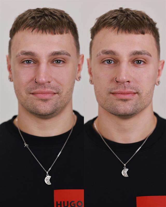 Unretouched before and after result, the drBand Clinic