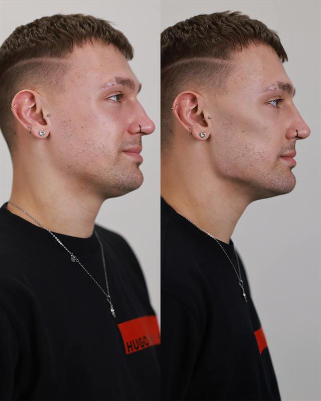 Unretouched before and after result, the drBand Clinic