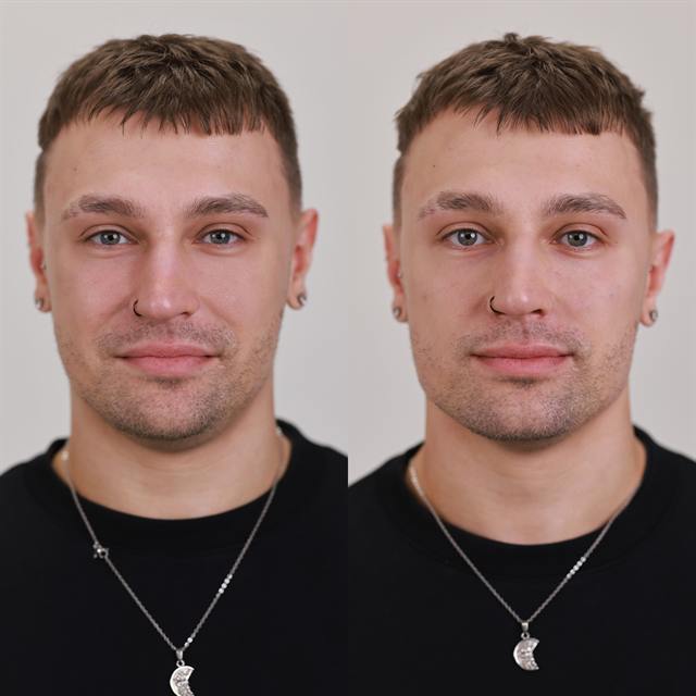 Unretouched before and after result, the drBand Clinic