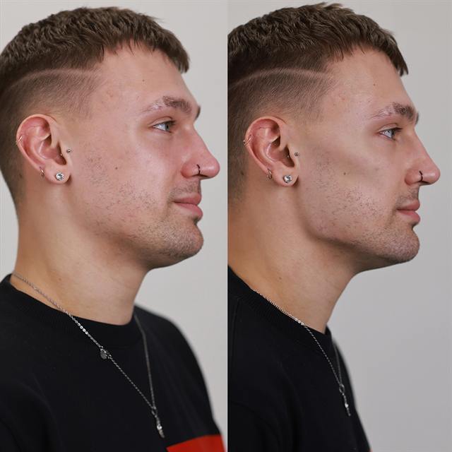 Unretouched before and after result, the drBand Clinic