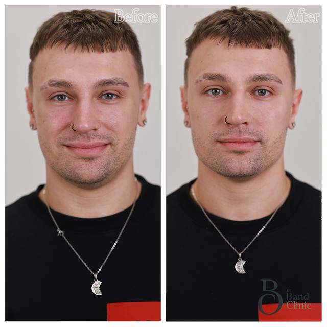 Unretouched before and after result, the drBand Clinic