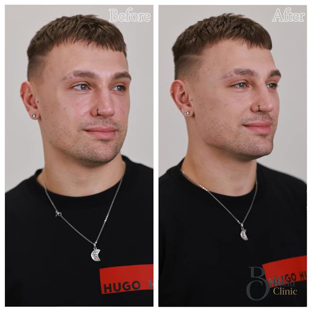 Unretouched before and after result, the drBand Clinic