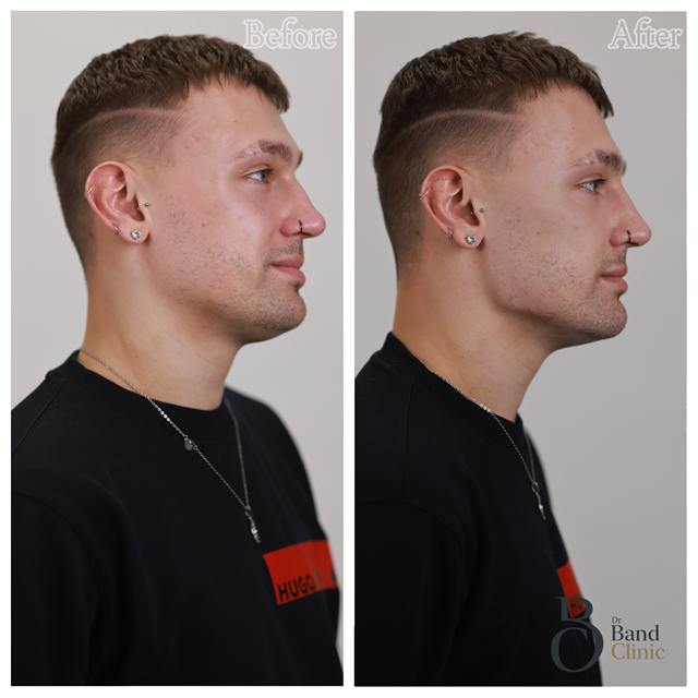 Unretouched before and after result, the drBand Clinic