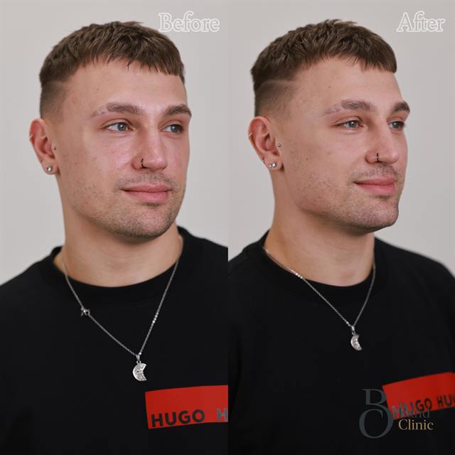 Unretouched before and after result, the drBand Clinic