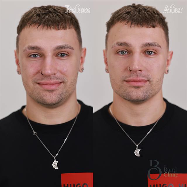 Unretouched before and after result, the drBand Clinic