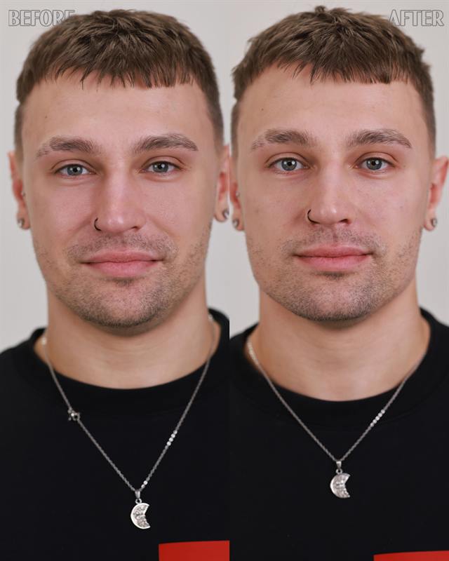 Unretouched before and after result, the drBand Clinic