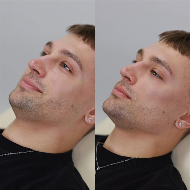 Unretouched before and after result, the drBand Clinic