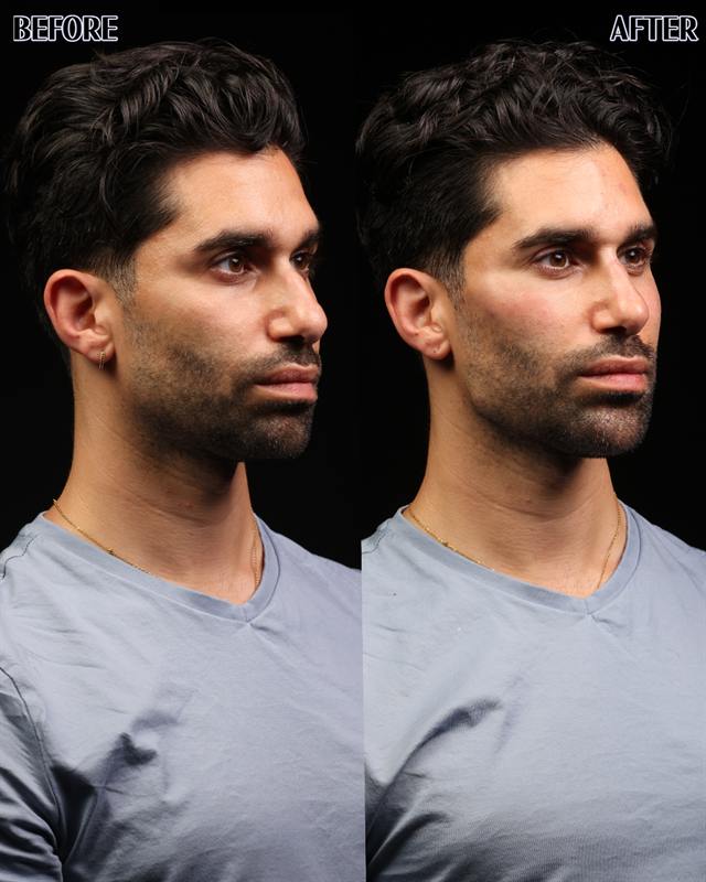 Unretouched before and after result, the drBand Clinic