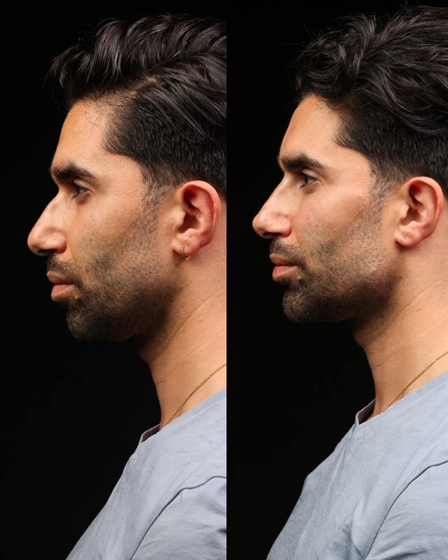 Unretouched before and after result, the drBand Clinic