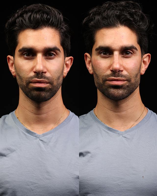 Unretouched before and after result, the drBand Clinic