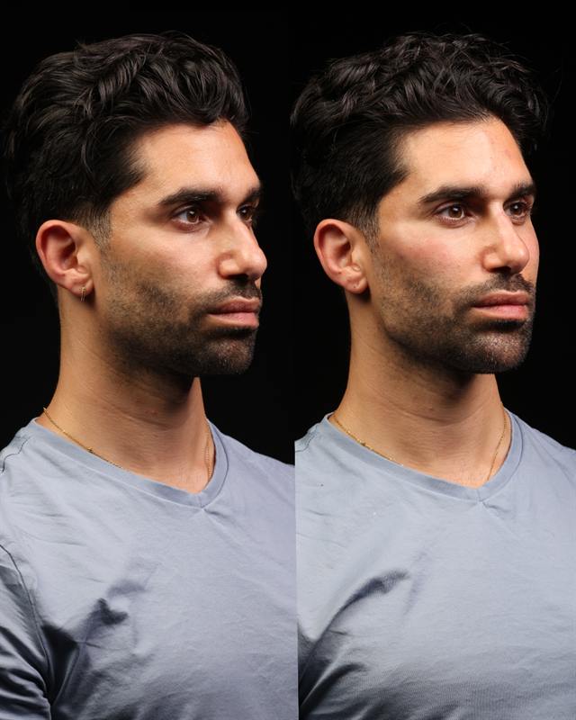 Unretouched before and after result, the drBand Clinic