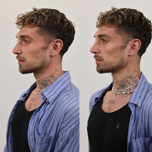 Unretouched before and after result, the drBand Clinic