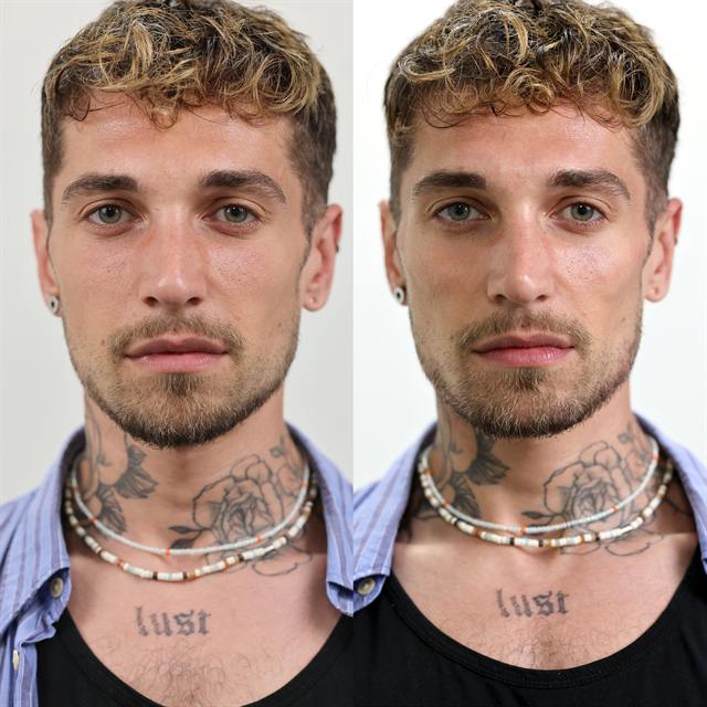 Unretouched before and after result, the drBand Clinic