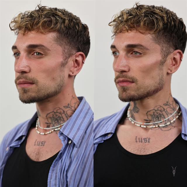 Unretouched before and after result, the drBand Clinic