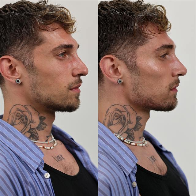 Unretouched before and after result, the drBand Clinic