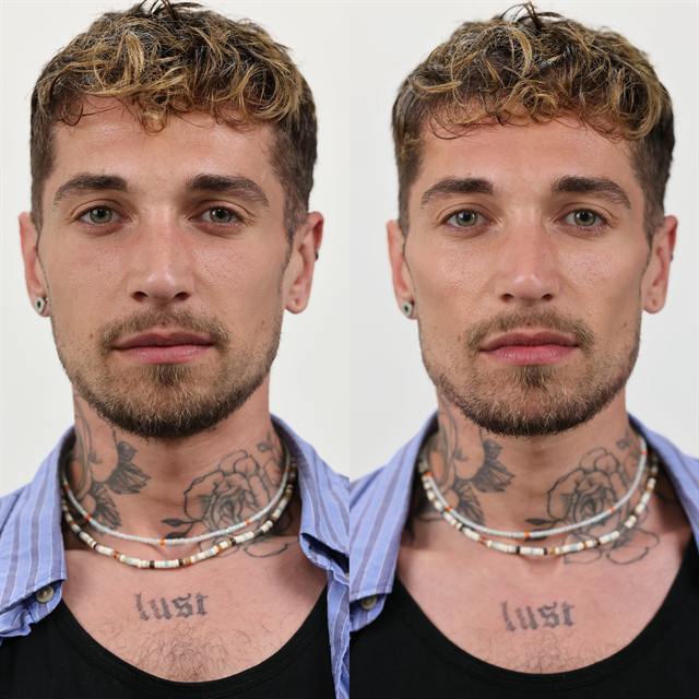 Unretouched before and after result, the drBand Clinic