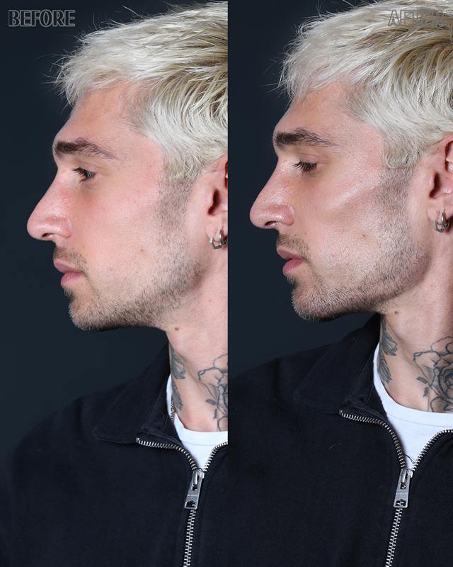 Unretouched before and after result, the drBand Clinic