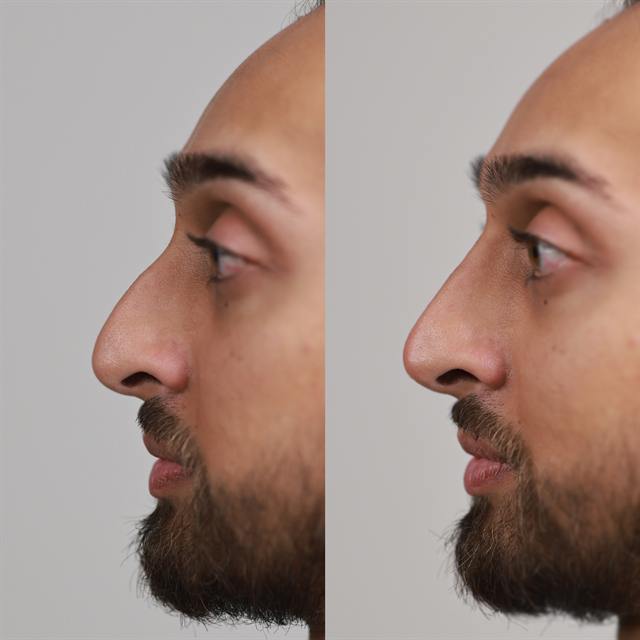 Unretouched before and after result, the drBand Clinic