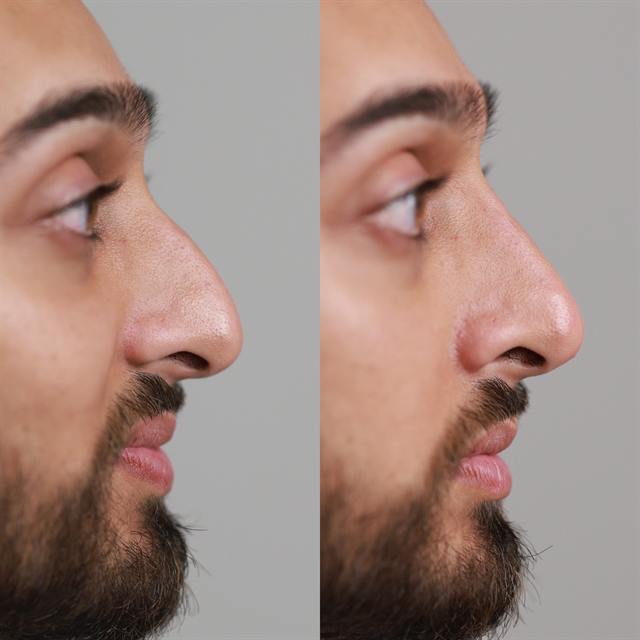 Unretouched before and after result, the drBand Clinic