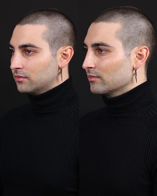 Unretouched before and after result, the drBand Clinic